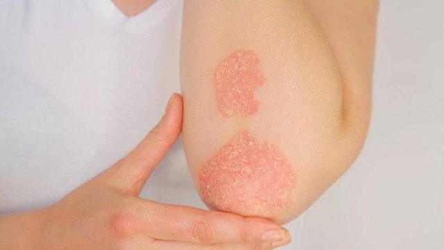 Giornata della psoriasi, Ucb conferma il suo impegno a fianco dei pazienti