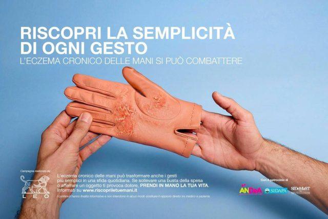 Mani che bruciano e fanno male, al via campagna su eczema cronico