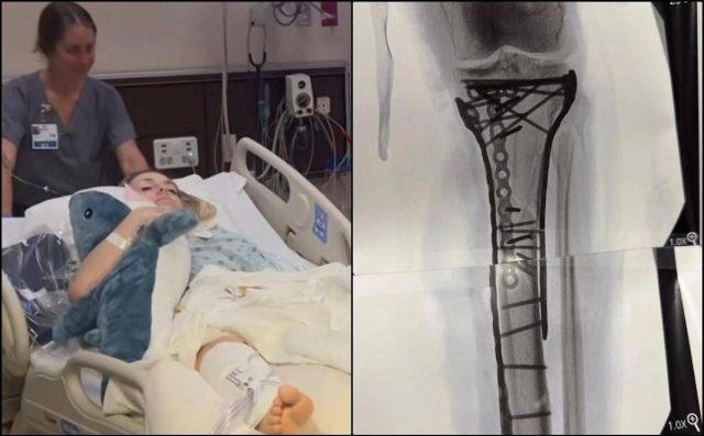 Milano Cortina, Vonn mostra la gamba dopo le operazioni: “Dolore difficile da gestire”
