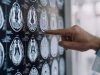 Centro Dbs Pavia, 100 interventi di neurostimolazione profonda per Parkinson