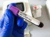 Tumore gastroesofageo Her2+, risultati positivi per tislelizumab con zanidatamab e chemio